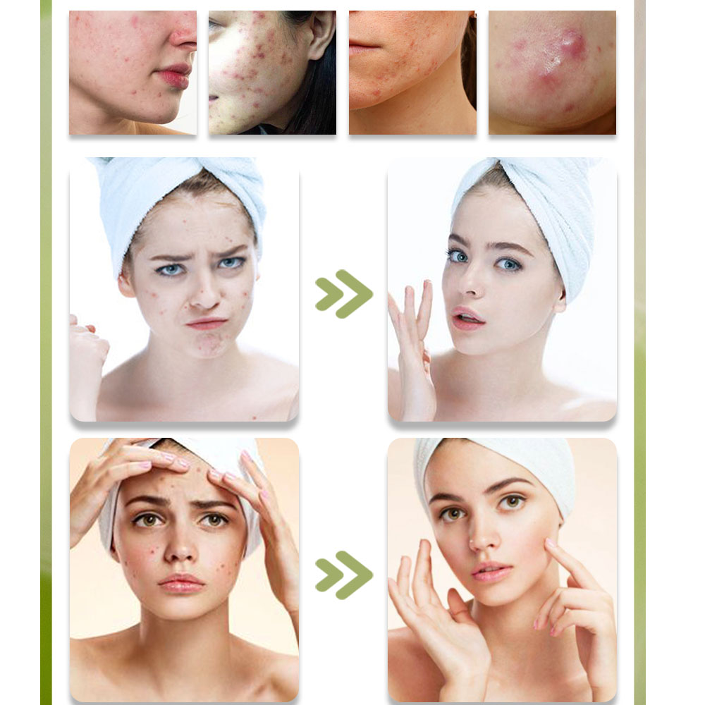 KStims Natural Acne Treatment  - Tea Tree Spot Treatment บทวิจารณ์และราคา
